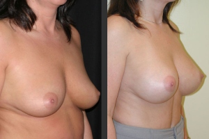 Breast Augmentation Side
