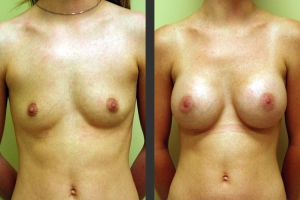 Breast Augmentation Front