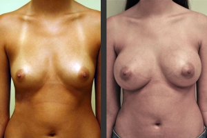 Breast Augmentation Front