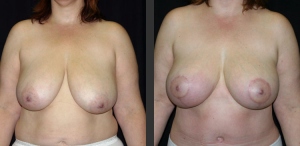 Breast Lift Front