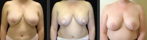 Breast Reconstruction Front