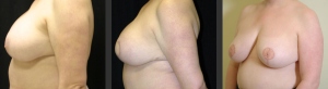 Breast Reconstruction Side