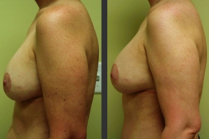 Breast Reconstruction Side