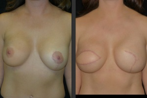 breast-reconstruc-diep-6-front