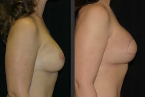 breast-reconstruc-diep-6-right
