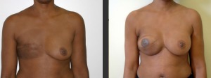 breast-reconstruc-diep-8-front