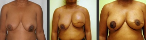 breast-reconstruc-diep-9-front