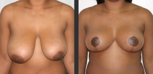 Breast Reduction Front