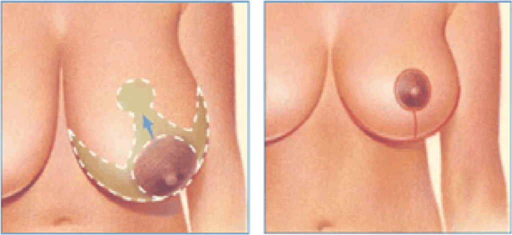 See Sharon's Breast Reduction Surgery on Embarrassing Bodies