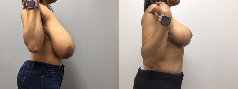 Breast Reduction Surgery