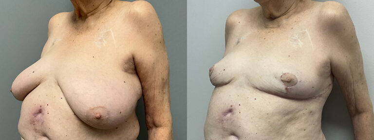 Breast Reduction Surgery