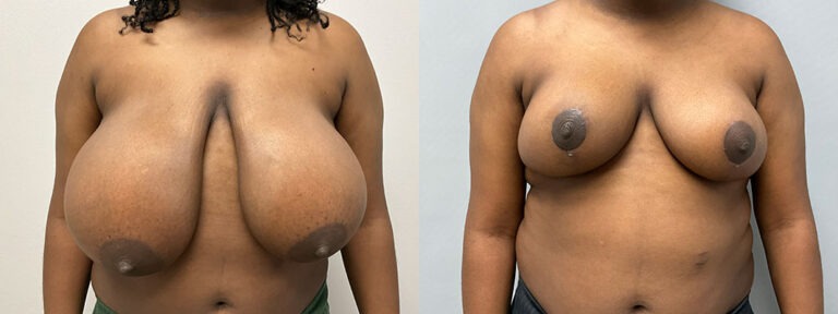 Breast Reduction Surgery