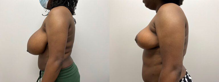 Breast Reduction Surgery