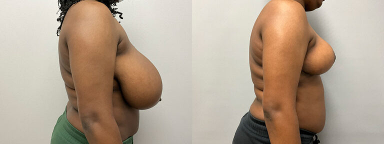Breast Reduction Surgery