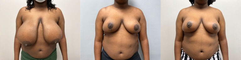 Breast Reduction Surgery
