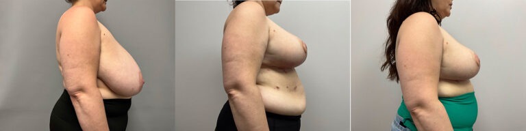Breast Reduction Surgery