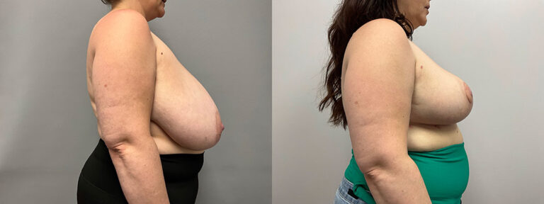 Breast Reduction Surgery