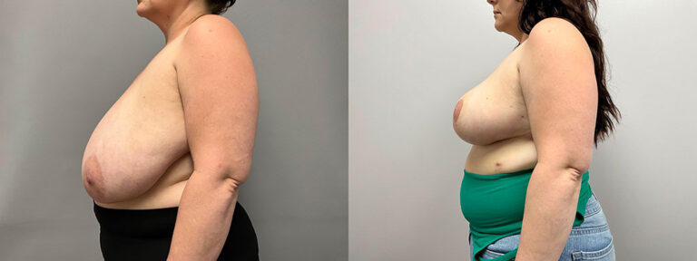 Breast Reduction Surgery