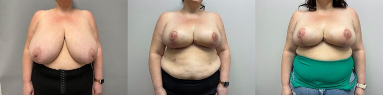 Breast Reduction Surgery