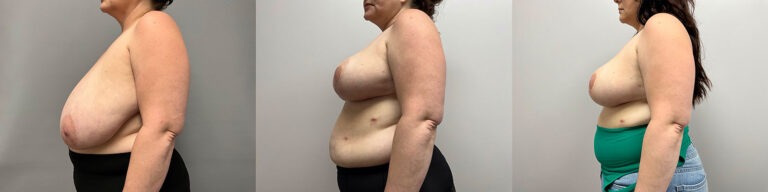 Breast Reduction Surgery
