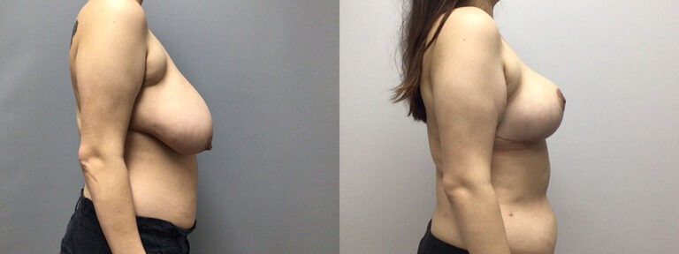 Breast Reduction Surgery