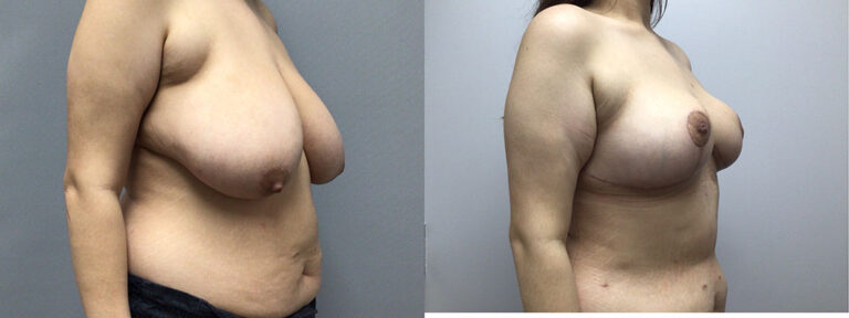 Breast Reduction Surgery