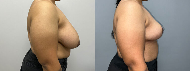 Breast Reduction Surgery