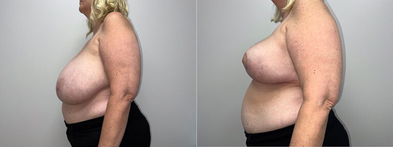 Breast Reduction Surgery