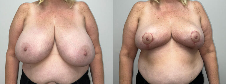 Breast Reduction Surgery