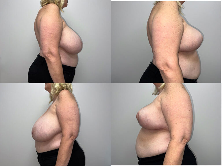Breast Reduction Surgery
