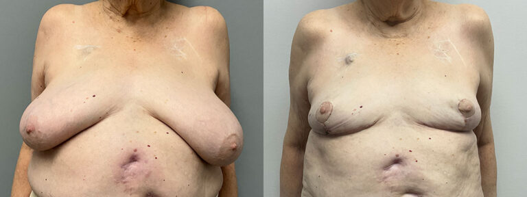 Breast Reduction Surgery