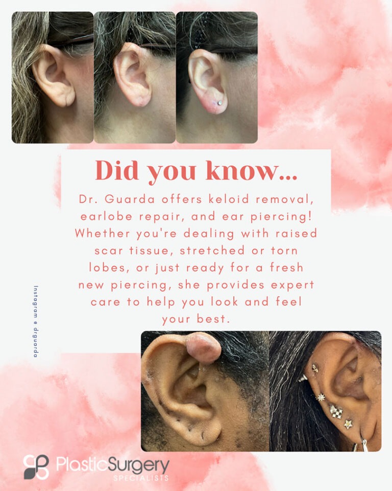 Earlobe Repair Keloid Removal