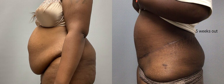 Panniculectomy Woman