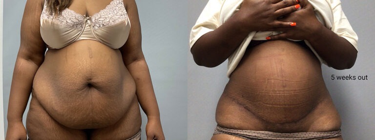 Panniculectomy Woman