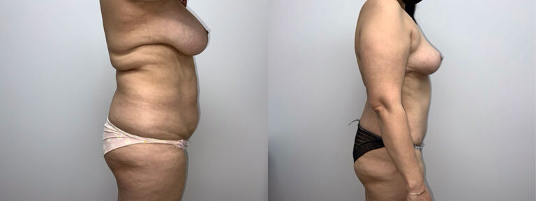 Panniculectomy Woman