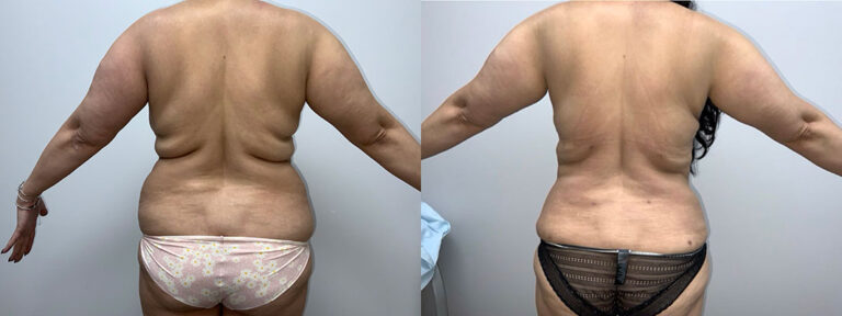 Panniculectomy Woman