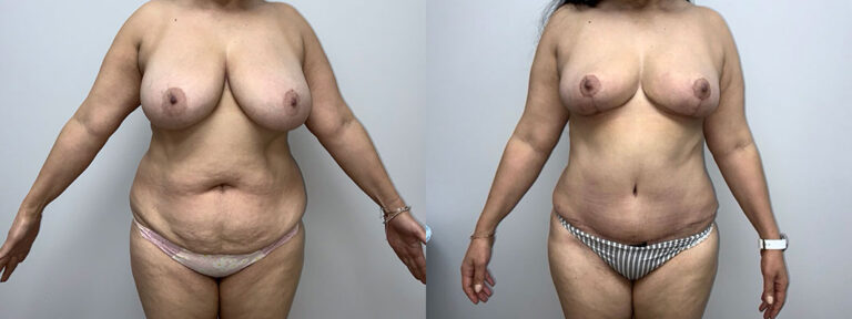 Panniculectomy Woman