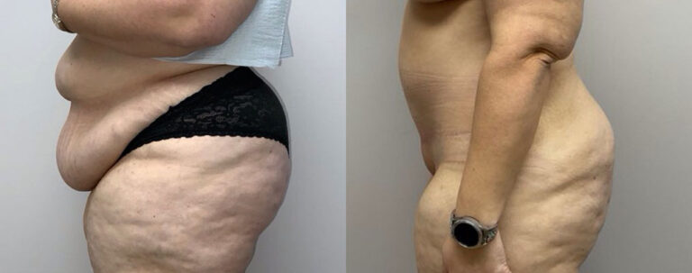 Panniculectomy Woman