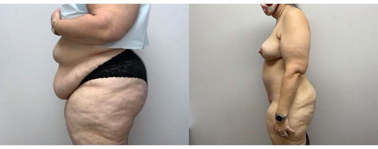 Panniculectomy Woman