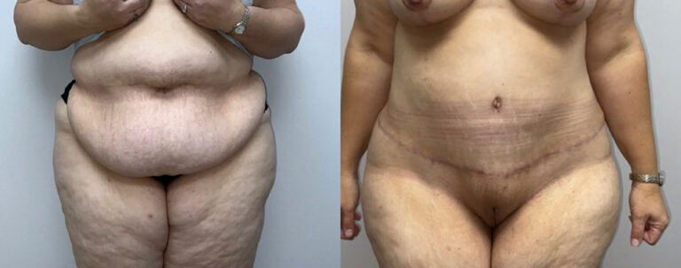 Panniculectomy Woman