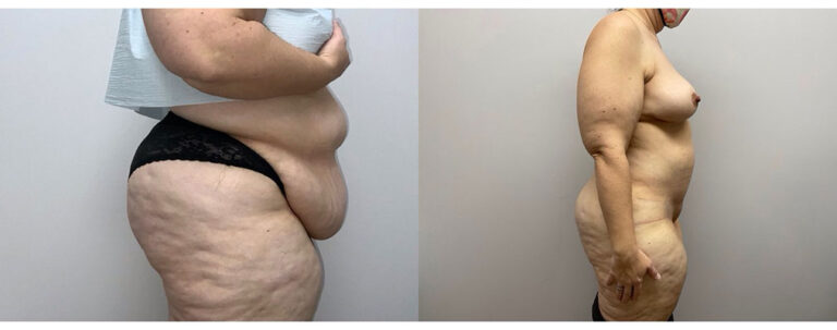 Panniculectomy Woman