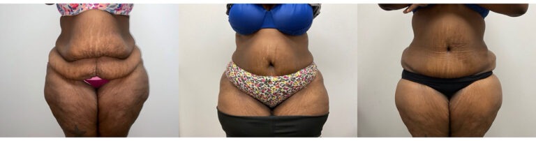 Panniculectomy Woman