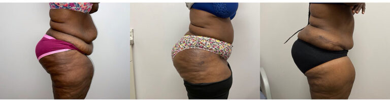 Panniculectomy Woman