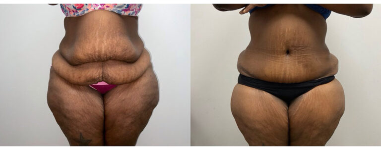 Panniculectomy Woman