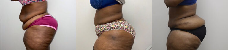 Panniculectomy Woman