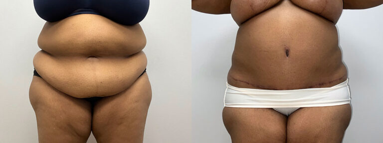 Panniculectomy Woman