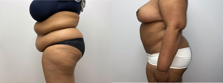 Panniculectomy Woman