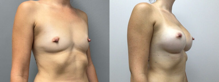 Breast Augmentation Surgery