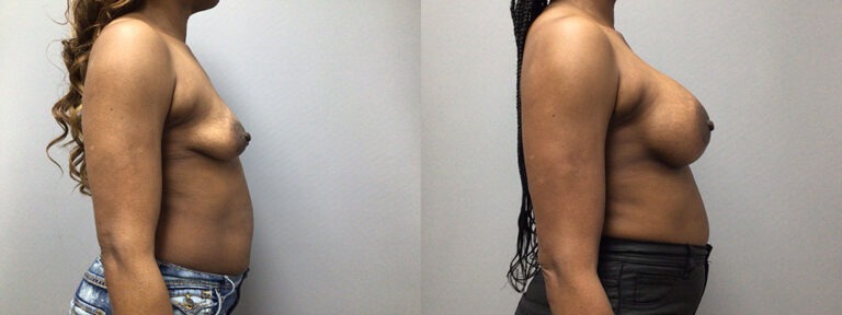 Breast Augmentation Surgery