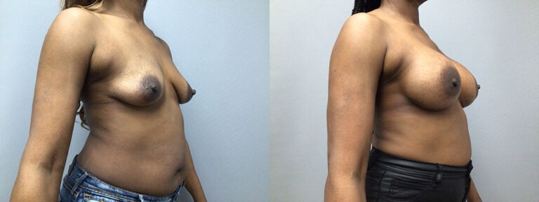 Breast Augmentation Surgery